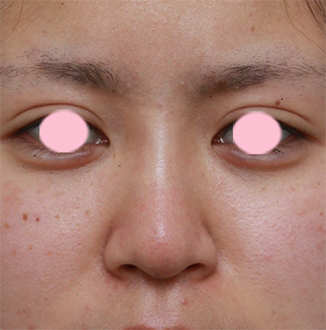 症例写真,鼻根部（鼻の目と目の間の部分）にヒアルロン酸注射して、鼻筋を通した症例写真,注射後3ヶ月,mainpic_ryubi12c.jpg