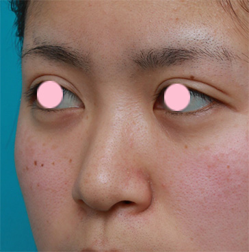 隆鼻注射（ヒアルロン酸注射）,鼻根部（鼻の目と目の間の部分）にヒアルロン酸注射して、鼻筋を通した症例写真,注射前,mainpic_ryubi12d.jpg