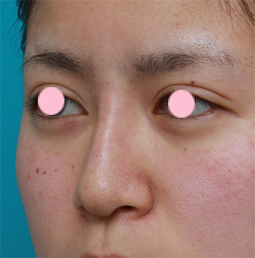隆鼻注射（ヒアルロン酸注射）,鼻根部（鼻の目と目の間の部分）にヒアルロン酸注射して、鼻筋を通した症例写真,注射直後,mainpic_ryubi12e.jpg