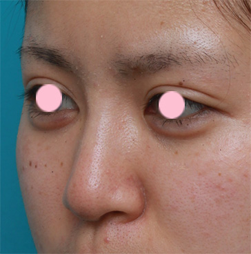 隆鼻注射（ヒアルロン酸注射）,鼻根部（鼻の目と目の間の部分）にヒアルロン酸注射して、鼻筋を通した症例写真,注射後3ヶ月,mainpic_ryubi12f.jpg