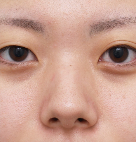 隆鼻注射（ヒアルロン酸注射）,ヒアルロン酸プチ整形で鼻を高くして鼻筋を通した症例写真,Before,ba_ryubi50_b.jpg