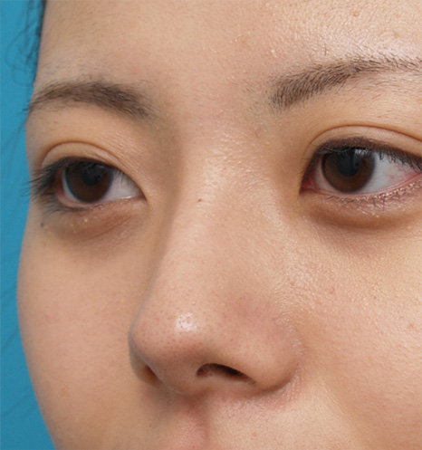 隆鼻注射（ヒアルロン酸注射）,ヒアルロン酸プチ整形で鼻を高くして鼻筋を通した症例写真,After,ba_ryubi51_b.jpg