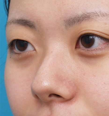 隆鼻注射（ヒアルロン酸注射）,ヒアルロン酸プチ整形で鼻を高くして鼻筋を通した症例写真,Before,ba_ryubi51_b.jpg