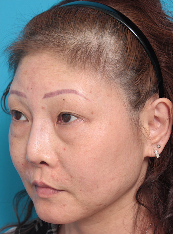 他院で受けた手術の修正（鼻）,隆鼻注射（ヒアルロン酸注射） 他院治療の修正症例,Before,ba_ryubichusha35_b.jpg