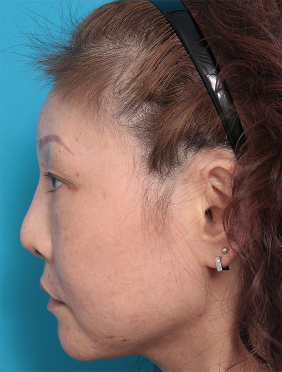 他院で受けた手術の修正（鼻）,隆鼻注射（ヒアルロン酸注射） 他院治療の修正症例,Before,ba_ryubichusha36_b.jpg
