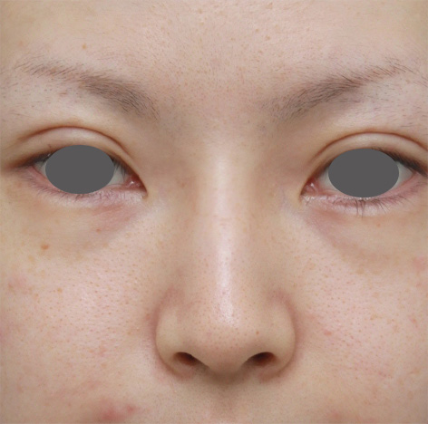 隆鼻注射（ヒアルロン酸注射）,長期持続型ヒアルロン酸を注射して鼻を高くし、ワシ鼻を目立たなくした症例写真,After（1週間後）,ba_ryubi52_b.jpg