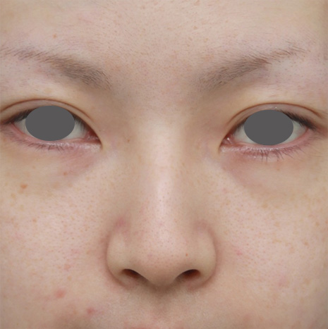 わし鼻・段鼻修正,ハンプ切除,長期持続型ヒアルロン酸を注射して鼻を高くし、ワシ鼻を目立たなくした症例写真,Before,ba_ryubi52_b.jpg
