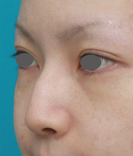 わし鼻・段鼻修正,ハンプ切除,長期持続型ヒアルロン酸を注射して鼻を高くし、ワシ鼻を目立たなくした症例写真,Before,ba_ryubi53_b.jpg