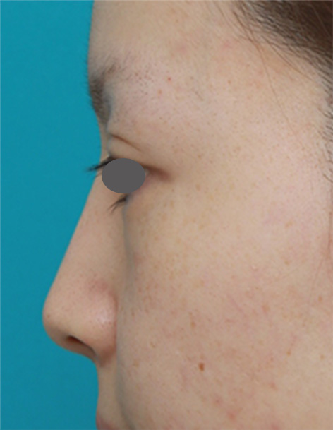 隆鼻注射（ヒアルロン酸注射）,長期持続型ヒアルロン酸を注射して鼻を高くし、ワシ鼻を目立たなくした症例写真,After（1週間後）,ba_ryubi54_b.jpg