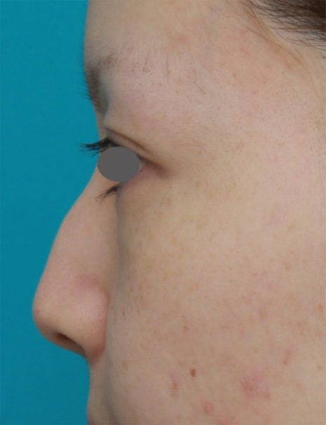 わし鼻・段鼻修正,ハンプ切除,長期持続型ヒアルロン酸を注射して鼻を高くし、ワシ鼻を目立たなくした症例写真,Before,ba_ryubi54_b.jpg