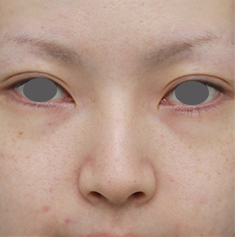 隆鼻注射（ヒアルロン酸注射）,長期持続型ヒアルロン酸を注射して鼻を高くし、ワシ鼻を目立たなくした症例写真,注射前,mainpic_ryubi13a.jpg
