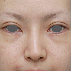 隆鼻注射（ヒアルロン酸注射）,長期持続型ヒアルロン酸を注射して鼻を高くし、ワシ鼻を目立たなくした症例写真,1週間後,mainpic_ryubi13c.jpg