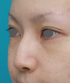 症例写真,長期持続型ヒアルロン酸を注射して鼻を高くし、ワシ鼻を目立たなくした症例写真,注射前,mainpic_ryubi13d.jpg