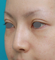 隆鼻注射（ヒアルロン酸注射）,長期持続型ヒアルロン酸を注射して鼻を高くし、ワシ鼻を目立たなくした症例写真,1週間後,mainpic_ryubi13f.jpg