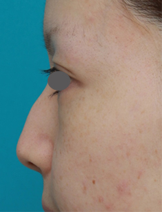 隆鼻注射（ヒアルロン酸注射）,長期持続型ヒアルロン酸を注射して鼻を高くし、ワシ鼻を目立たなくした症例写真,注射前,mainpic_ryubi13g.jpg