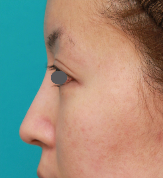 耳介軟骨移植（鼻先を出す）,長期持続型ヒアルロン酸注射+耳介軟骨移植で鼻筋を通して鼻先を斜め下方向に出した症例写真,After（3ヶ月後）,ba_ryubichusha39_b.jpg