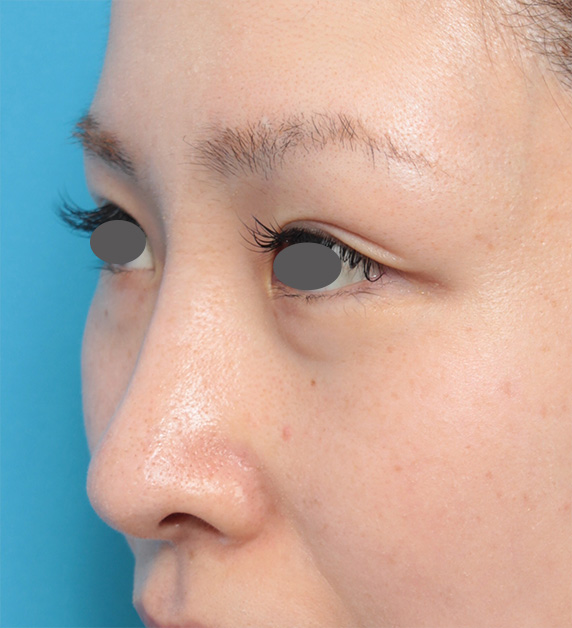 症例写真,長期持続型ヒアルロン酸注射で鼻を高くして鼻筋を通した症例写真の術前術後画像の解説,After（1週間後）,ba_ryubichusha43_b.jpg