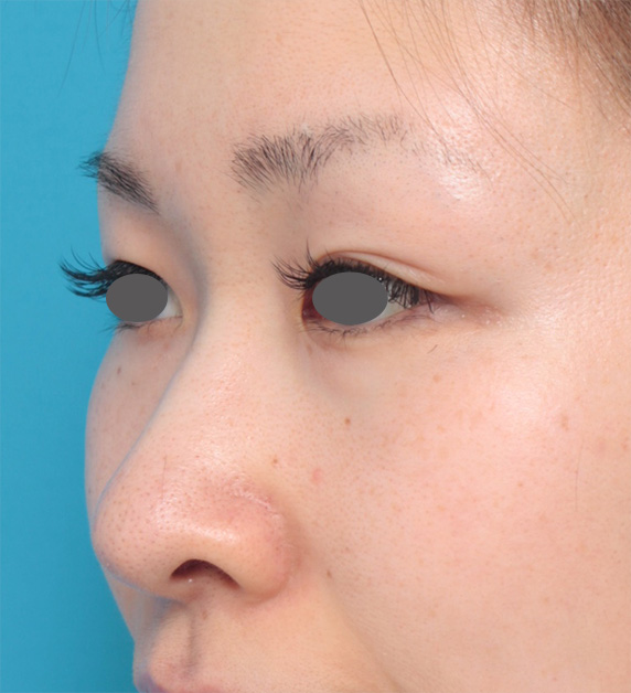 隆鼻注射（ヒアルロン酸注射）,長期持続型ヒアルロン酸注射で鼻を高くして鼻筋を通した症例写真の術前術後画像の解説,Before,ba_ryubichusha43_b.jpg