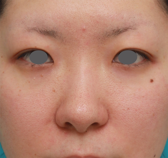 隆鼻注射（ヒアルロン酸注射）,長期持続型ヒアルロン酸注射で鼻を高くし、綺麗に鼻筋を通した症例写真,Before,ba_ryubichusha44_b.jpg