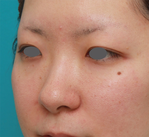 隆鼻注射（ヒアルロン酸注射）,長期持続型ヒアルロン酸注射で鼻を高くし、綺麗に鼻筋を通した症例写真,Before,ba_ryubichusha45_b.jpg