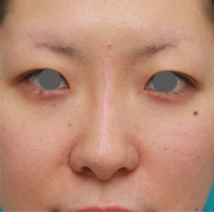 症例写真,長期持続型ヒアルロン酸注射で鼻を高くし、綺麗に鼻筋を通した症例写真,注射直後,mainpic_ryubichusha02b.jpg
