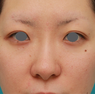 隆鼻注射（ヒアルロン酸注射）,長期持続型ヒアルロン酸注射で鼻を高くし、綺麗に鼻筋を通した症例写真,1週間後,mainpic_ryubichusha02d.jpg