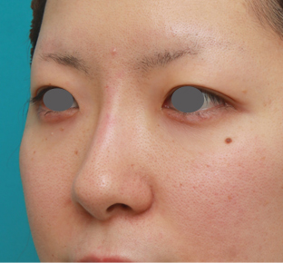 隆鼻注射（ヒアルロン酸注射）,長期持続型ヒアルロン酸注射で鼻を高くし、綺麗に鼻筋を通した症例写真,注射直後,mainpic_ryubichusha02f.jpg