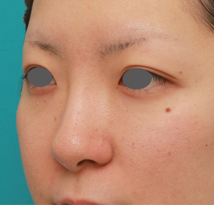 隆鼻注射（ヒアルロン酸注射）,長期持続型ヒアルロン酸注射で鼻を高くし、綺麗に鼻筋を通した症例写真,1週間後,mainpic_ryubichusha02h.jpg