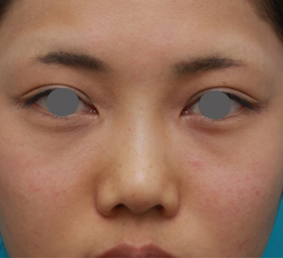 症例写真,ヒアルロン酸注射と耳介軟骨移植で鼻のバランスを整えた症例写真の術前術後画像,手術前,mainpic_ryubichusha03a.jpg