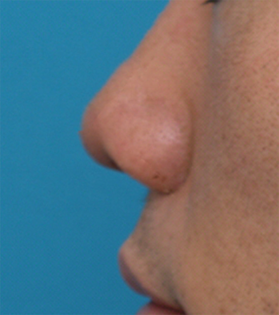 耳介軟骨移植（鼻先を出す）,耳介軟骨移植（鼻先を出す）の症例 鼻先がもっさりとした印象の20代男性,After,ba_jikai12_b.jpg