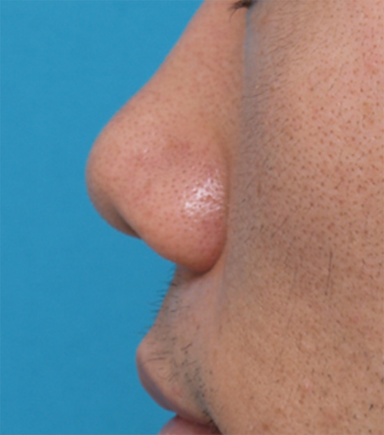 耳介軟骨移植（鼻先を出す）,耳介軟骨移植（鼻先を出す）の症例 鼻先がもっさりとした印象の20代男性,Before,ba_jikai12_b.jpg