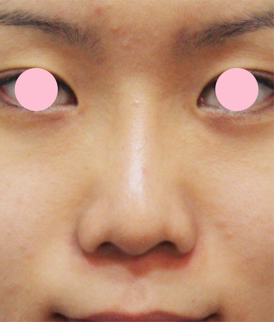 鼻翼縮小（小鼻縮小）,鼻翼縮小（小鼻縮小）の症例写真 小鼻の張り出しを改善,手術前,mainpic_biyoku02a.jpg