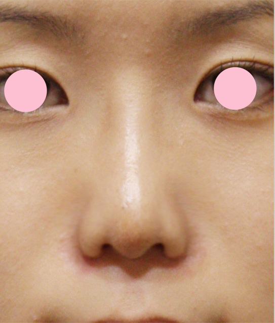 鼻翼縮小（小鼻縮小）,鼻翼縮小（小鼻縮小）の症例写真 小鼻の張り出しを改善,1週間後,mainpic_biyoku02c.jpg