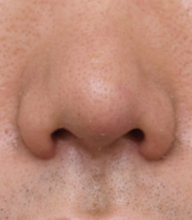 鼻翼縮小（小鼻縮小）,鼻翼縮小（小鼻縮小）の症例写真  鼻の穴が目立つ男性,After,ba_biyoku15_b.jpg