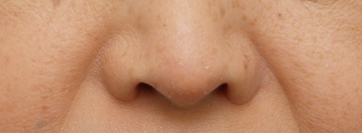 鼻翼縮小（小鼻縮小）,鼻翼縮小（小鼻縮小）の症例写真  小鼻が大きく目立つ,After,ba_biyoku14_a01.jpg