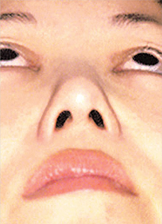 鼻翼縮小（小鼻縮小）,鼻翼縮小（小鼻縮小）の症例写真  横に広がった小鼻,After,ba_biyoku12_b.jpg