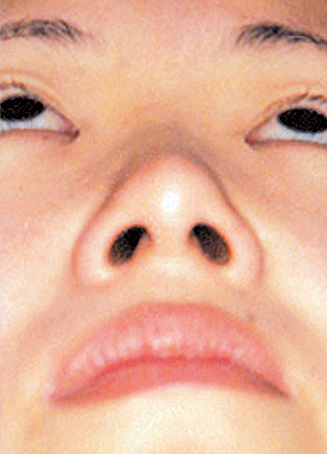 鼻翼縮小（小鼻縮小）,鼻翼縮小（小鼻縮小）の症例写真  横に広がった小鼻,Before,ba_biyoku12_b.jpg