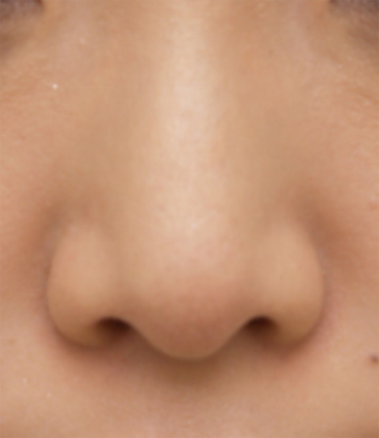 鼻翼縮小（小鼻縮小）,鼻翼縮小（小鼻縮小）の症例写真  小鼻が広がっている,After,ba_biyoku11_a01.jpg