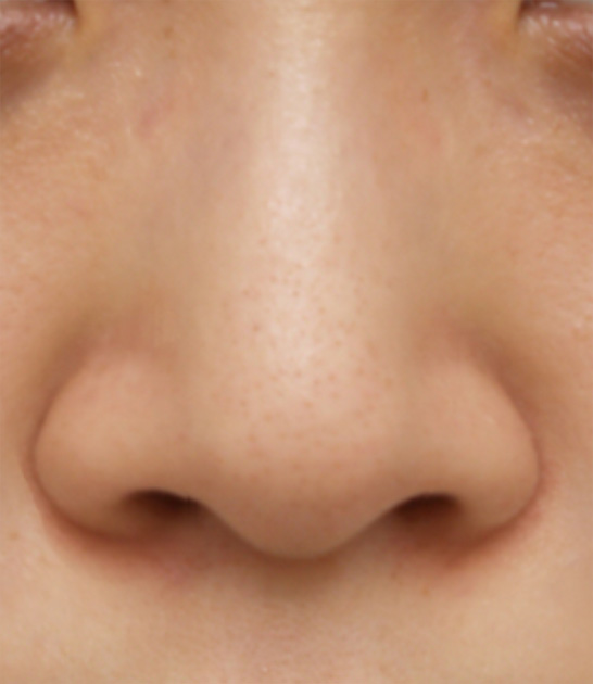 鼻翼縮小（小鼻縮小）,鼻翼縮小（小鼻縮小）の症例写真  小鼻が広がっている,Before,ba_biyoku11_b.jpg
