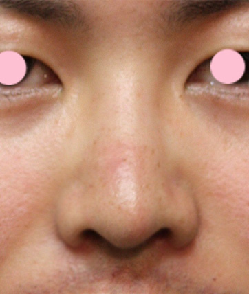 鼻翼縮小（小鼻縮小）,鼻翼縮小（小鼻縮小）の症例写真  上向きで大きい鼻の穴,After,ba_biyoku16_b.jpg