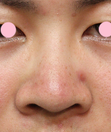 鼻翼縮小（小鼻縮小）,鼻翼縮小（小鼻縮小）の症例写真  上向きで大きい鼻の穴,Before,ba_biyoku16_b.jpg