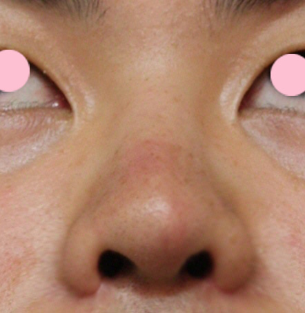 鼻翼縮小（小鼻縮小）,鼻翼縮小（小鼻縮小）の症例写真  上向きで大きい鼻の穴,After,ba_biyoku17_b.jpg