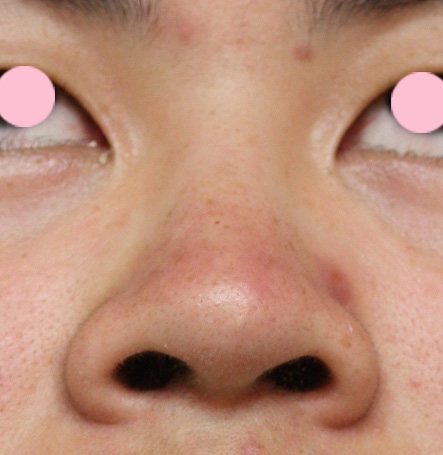 症例写真,鼻翼縮小（小鼻縮小）の症例写真  上向きで大きい鼻の穴,Before,ba_biyoku17_b.jpg