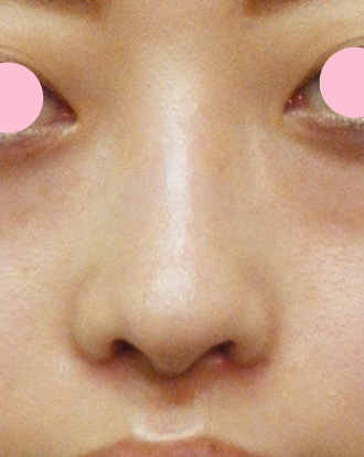 鼻翼縮小（小鼻縮小）,鼻翼縮小（小鼻縮小）の症例写真  大きく目立つ鼻の穴,After（1週間後）,ba_biyoku10_a01.jpg
