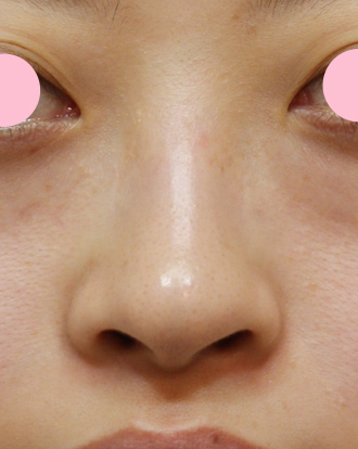 症例写真,鼻翼縮小（小鼻縮小）の症例写真  大きく目立つ鼻の穴,Before,ba_biyoku10_b.jpg