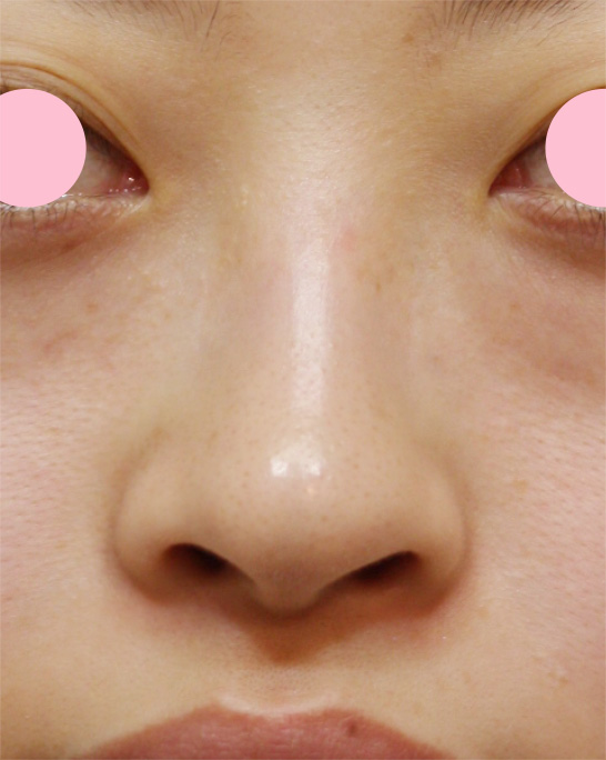 鼻翼縮小（小鼻縮小）,鼻翼縮小（小鼻縮小）の症例写真  大きく目立つ鼻の穴,手術前,mainpic_biyoku01a.jpg