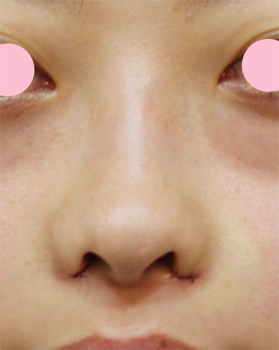 症例写真,鼻翼縮小（小鼻縮小）の症例写真  大きく目立つ鼻の穴,手術直後,mainpic_biyoku01b.jpg
