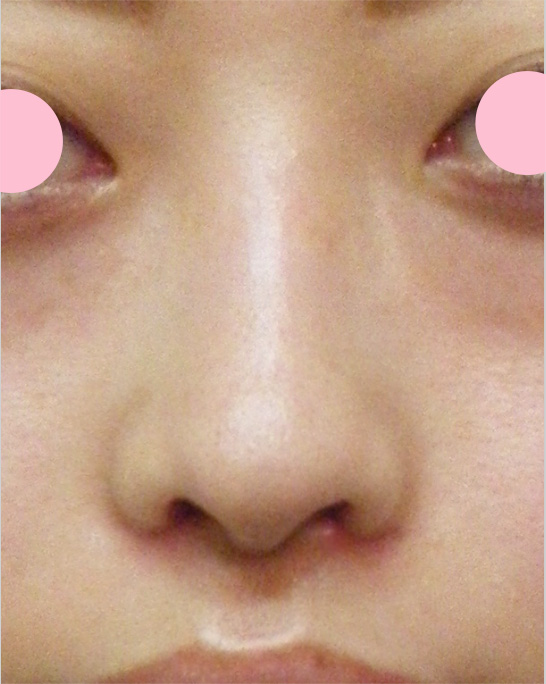 鼻翼縮小（小鼻縮小）,鼻翼縮小（小鼻縮小）の症例写真  大きく目立つ鼻の穴,1週間後,mainpic_biyoku01c.jpg