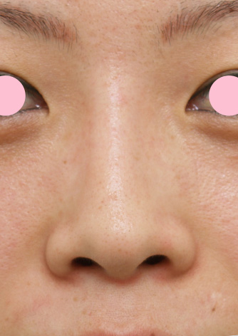 鼻翼縮小（小鼻縮小）,鼻翼縮小（小鼻縮小）の症例写真　大きな小鼻を小さく,Before,ba_biyoku08_b.jpg