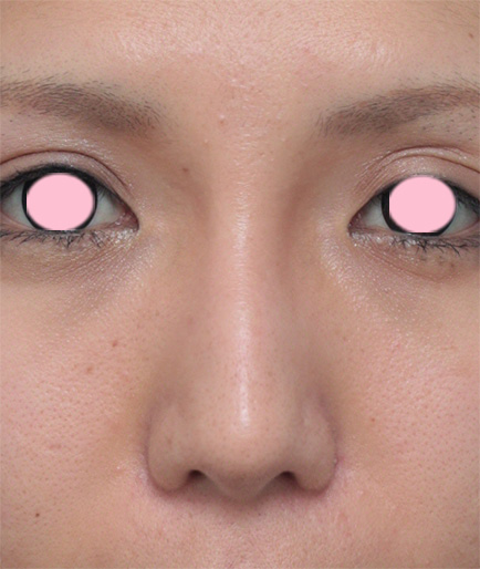 鼻翼縮小（小鼻縮小）,鼻翼（小鼻）縮小+鼻のヒアルロン酸注射症例写真,After（1ヶ月後）,ba_biyoku18_b.jpg